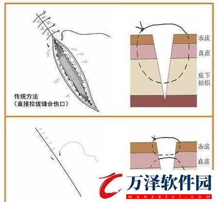 竹板打腫臂縫合不上